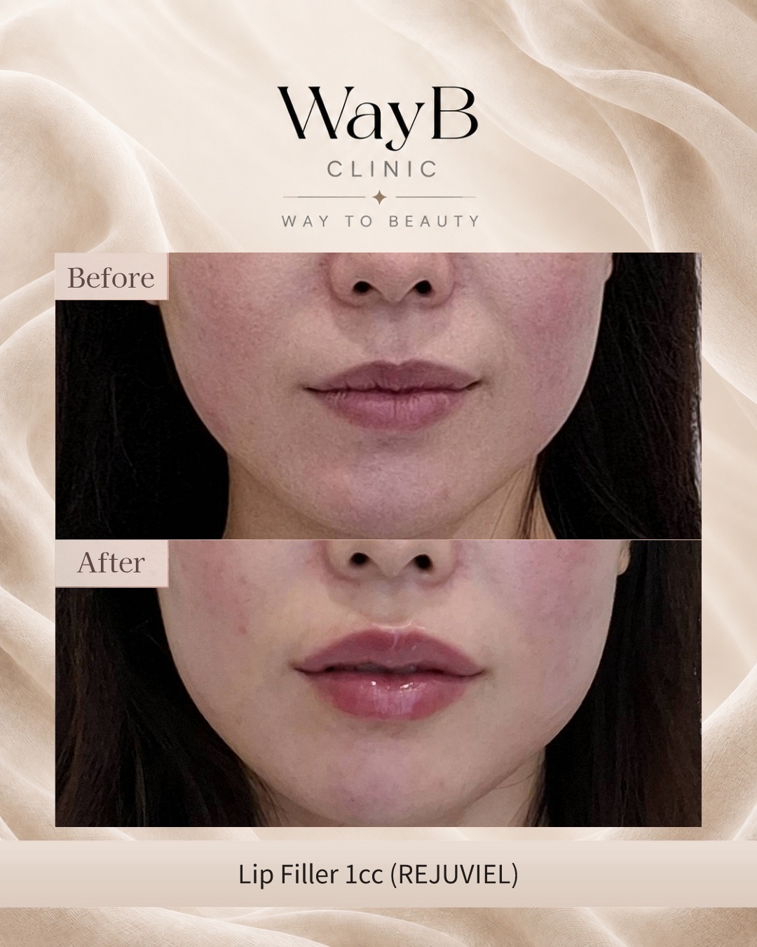 Lip Filler Case 1 Before & After