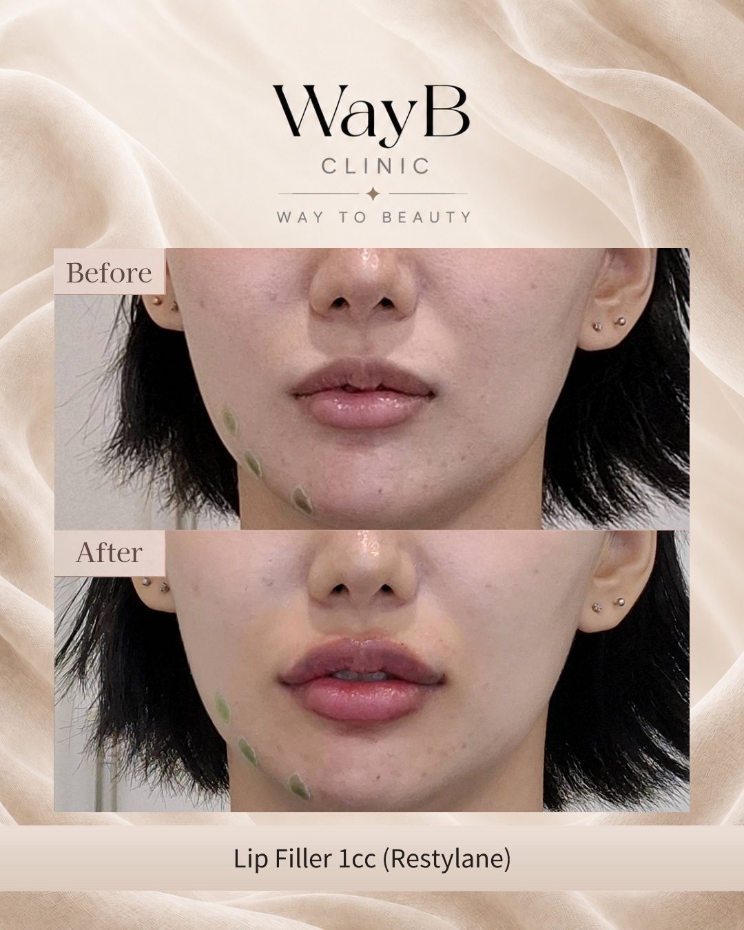 Lip Filler Case 2 Before & After