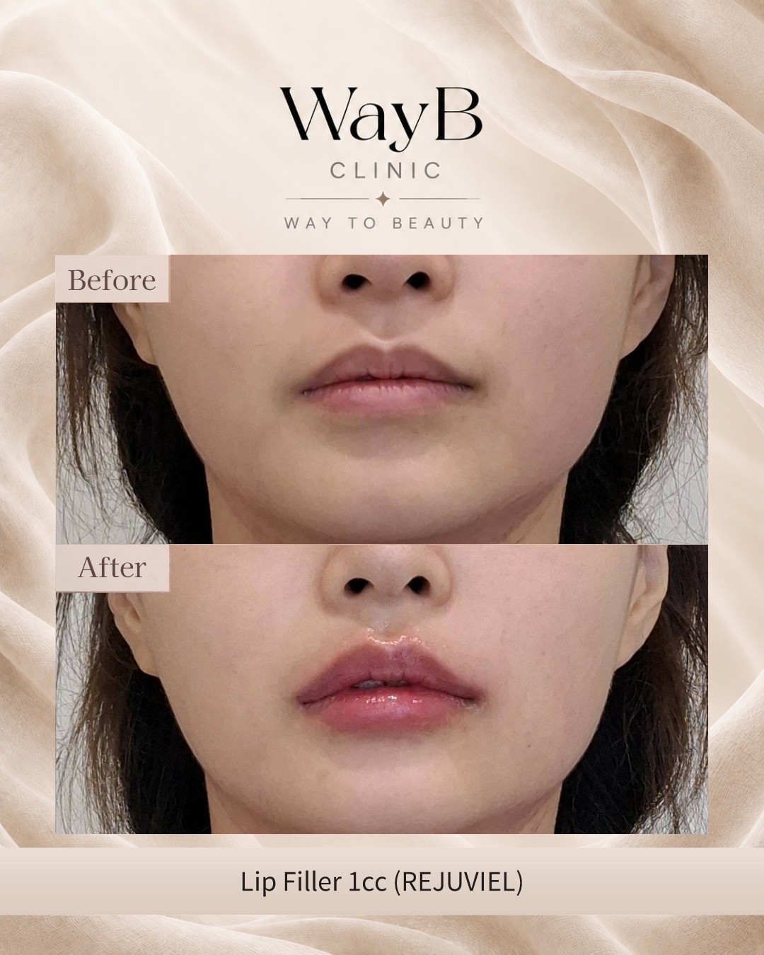 Lip Filler Case 3 Before & After