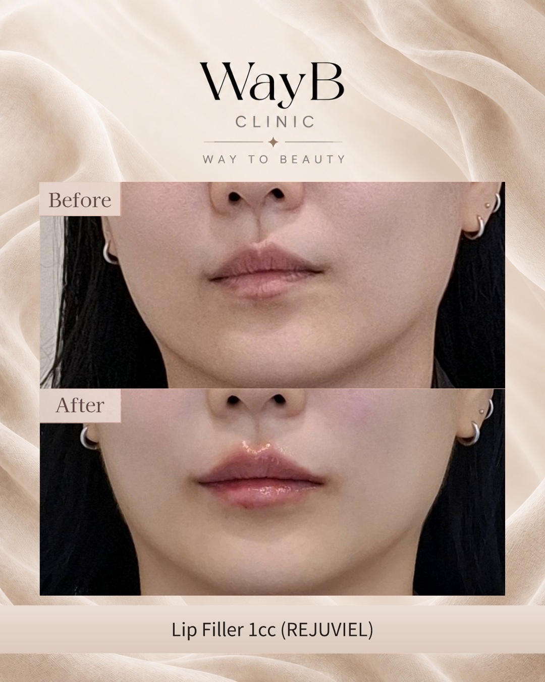 Lip Filler Case 4 Before & After