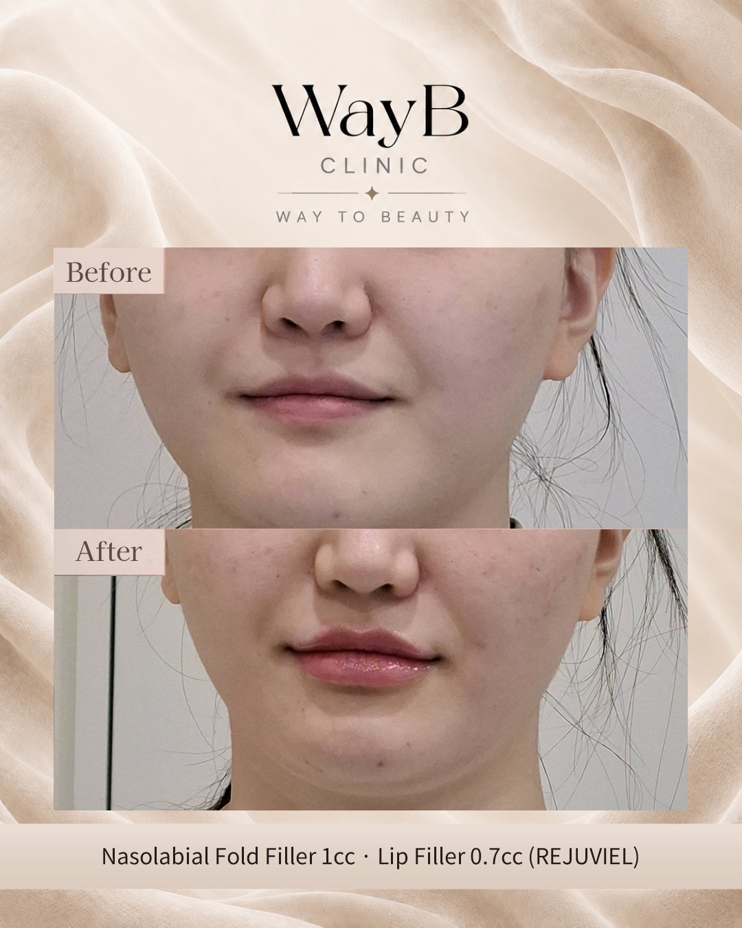 Nasolabial Fold Filler Case 1 Before & After