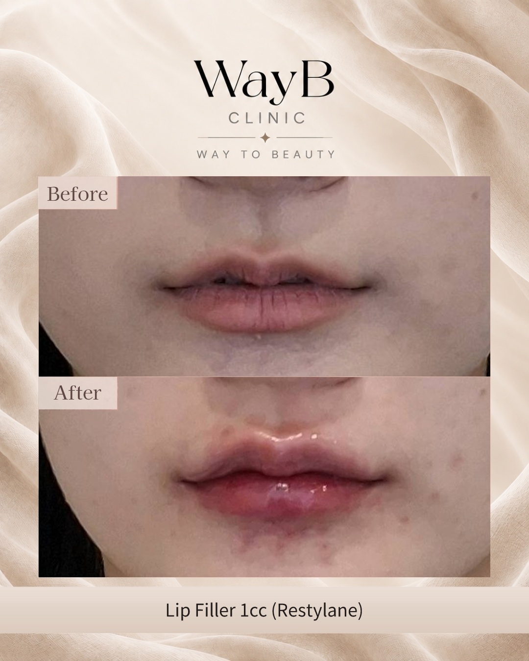 Lip Filler Case 6 Before & After
