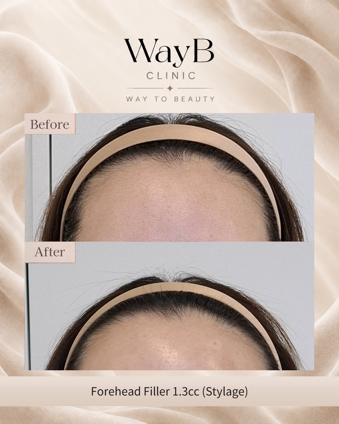 Forehead Filler Case 1 Before & After