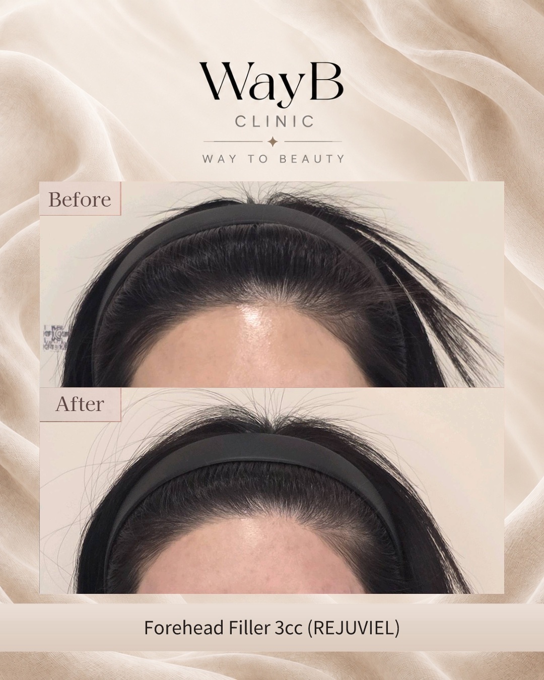 Forehead Filler Case 2 Before & After