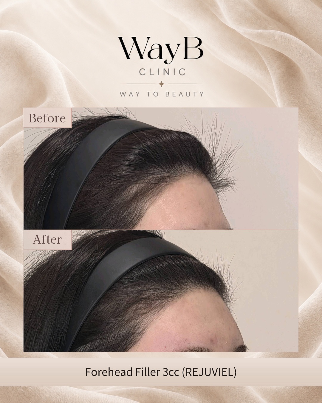 Forehead Filler Case 2 Before & After