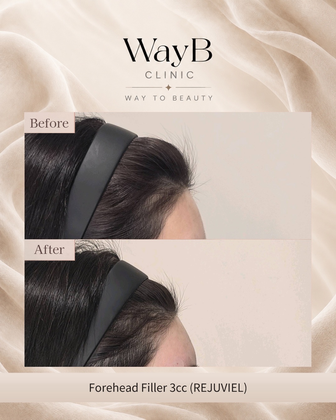Forehead Filler Case 2 Before & After
