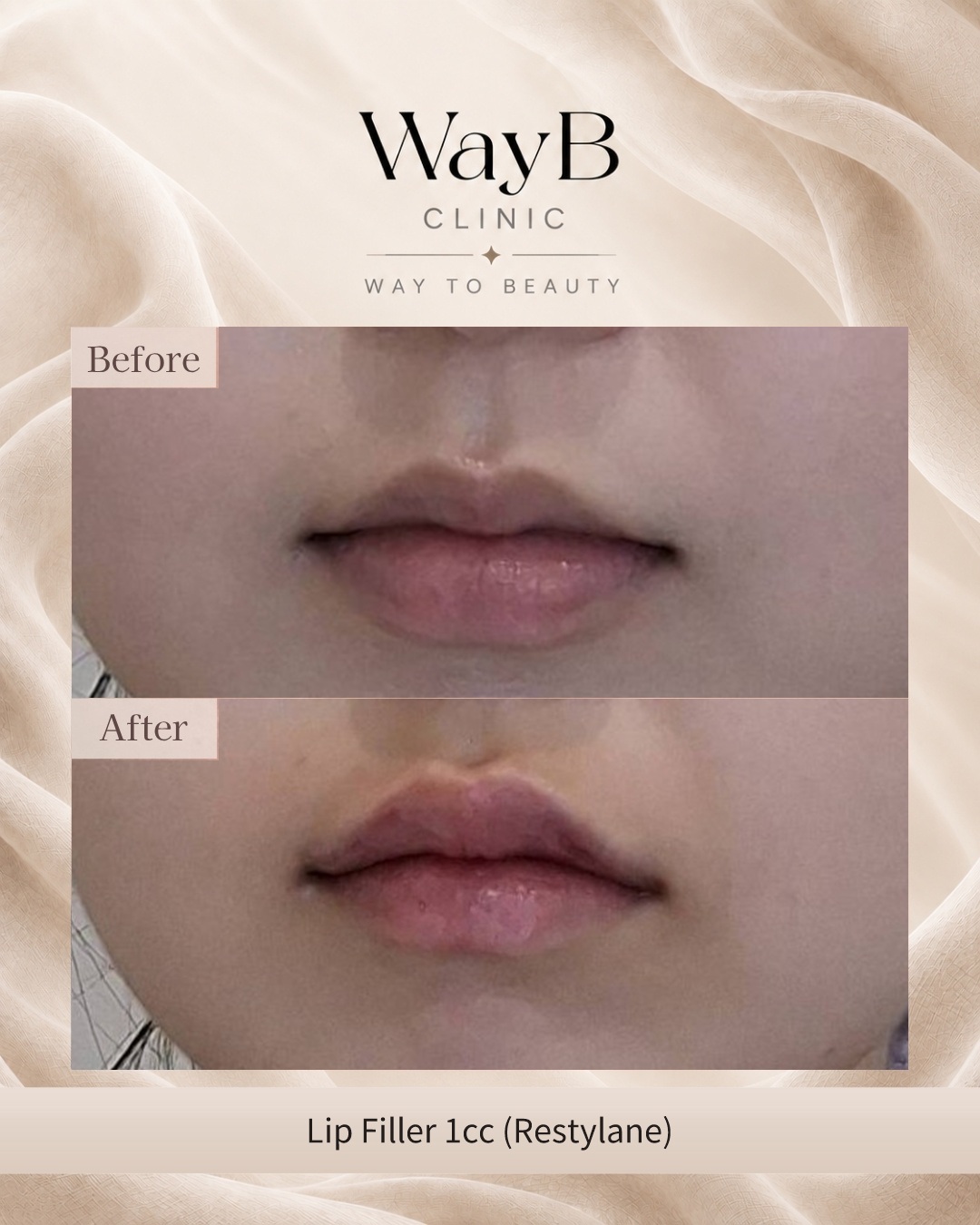 Lip Filler Case 7 Before & After