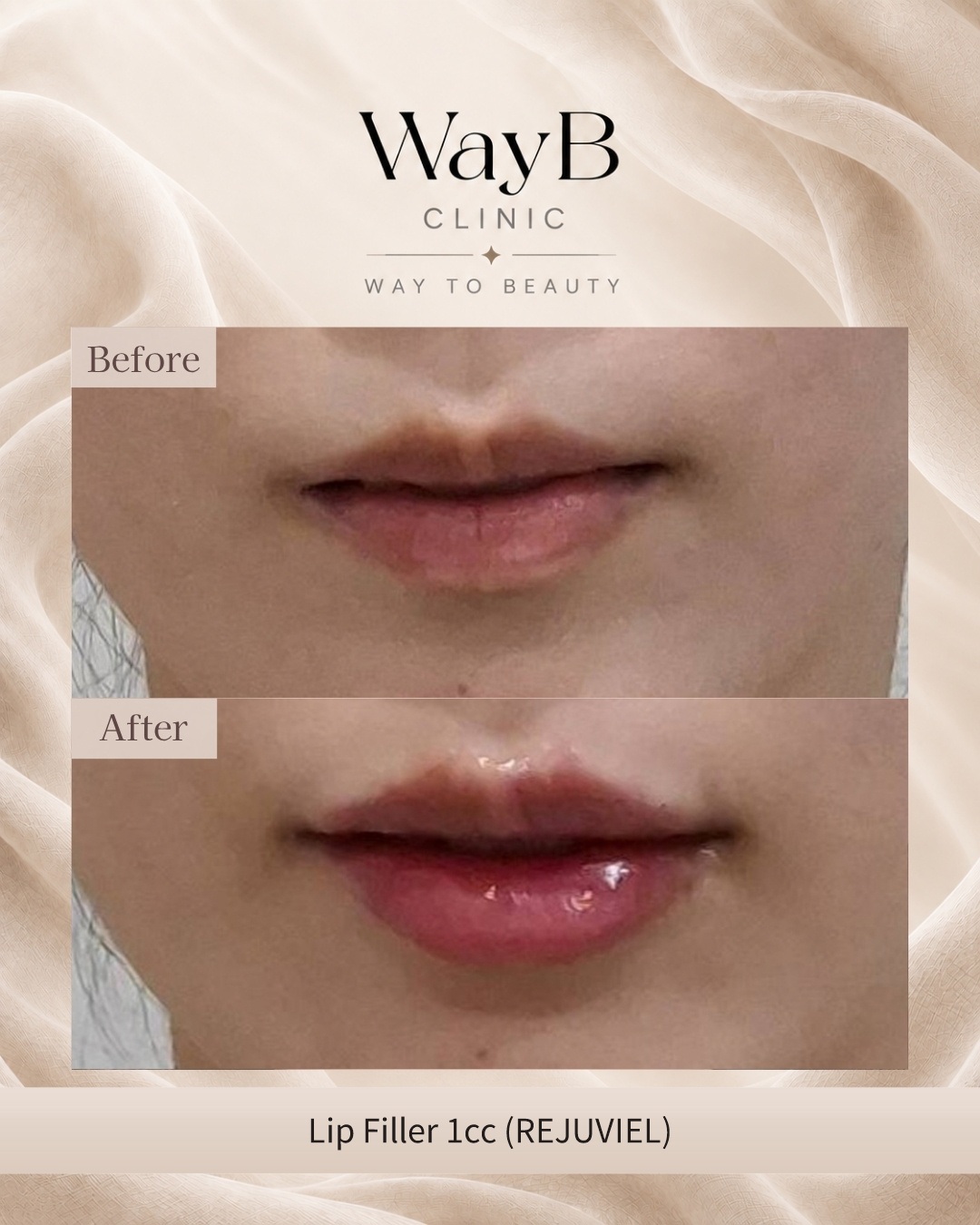 Lip Filler Case 8 Before & After