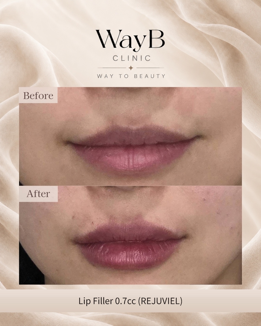 Lip Filler Case 9 Before & After