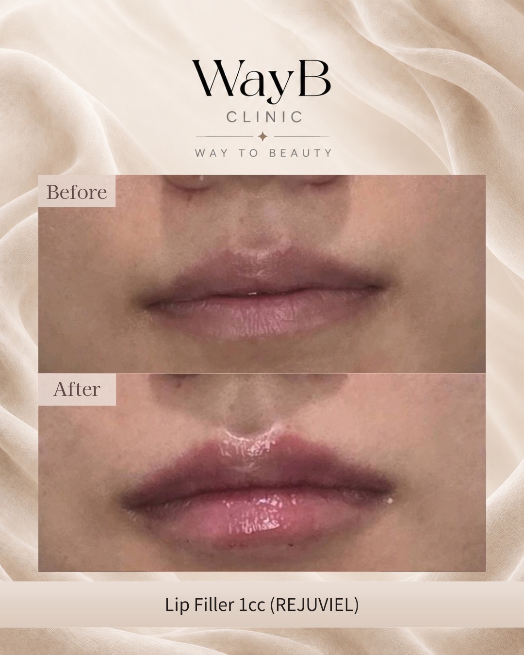 Lip Filler Case 10 Before & After