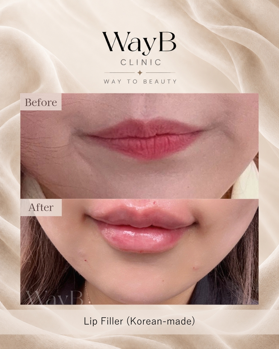 Lip Filler Case 11 Before & After