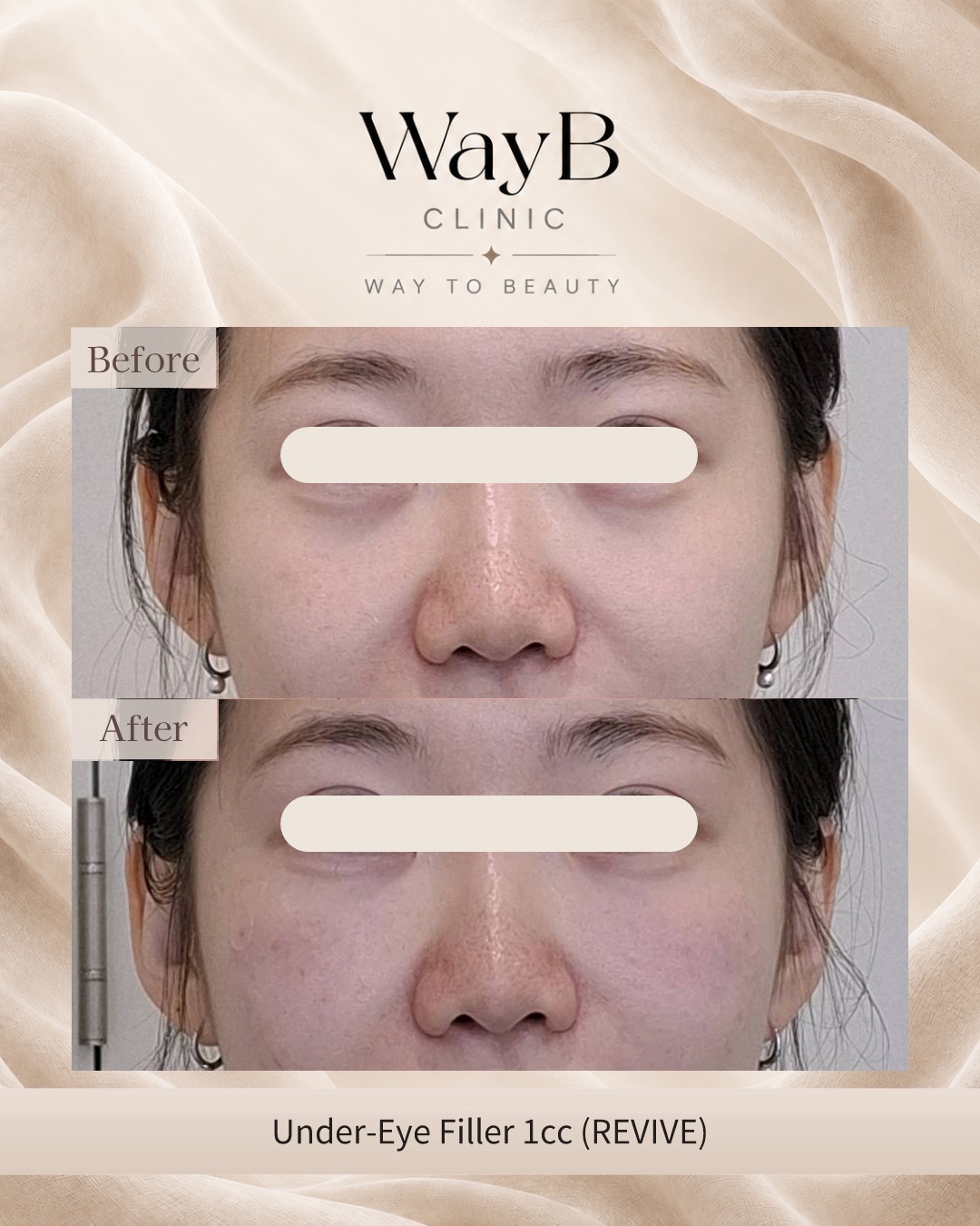 Under-Eye Filler Case 1 Before & After