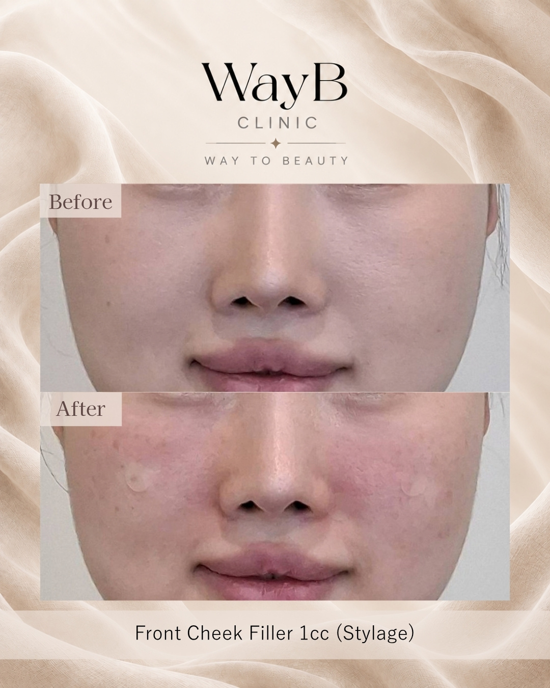 Cheek Filler Case 5 Before & After