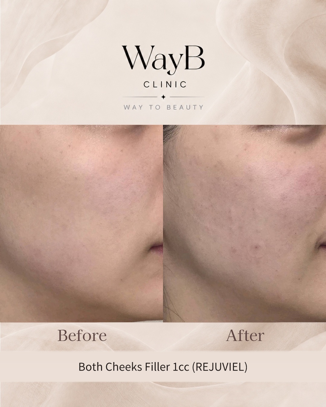 Cheek Filler Case 6 Before & After