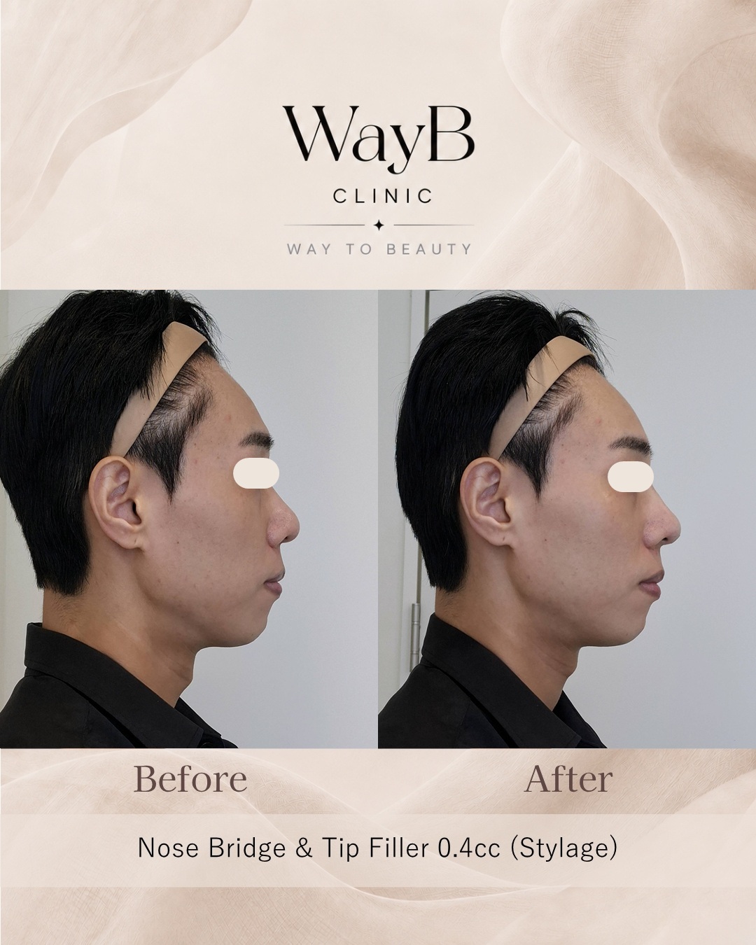 Nose Filler Case 1 Before & After