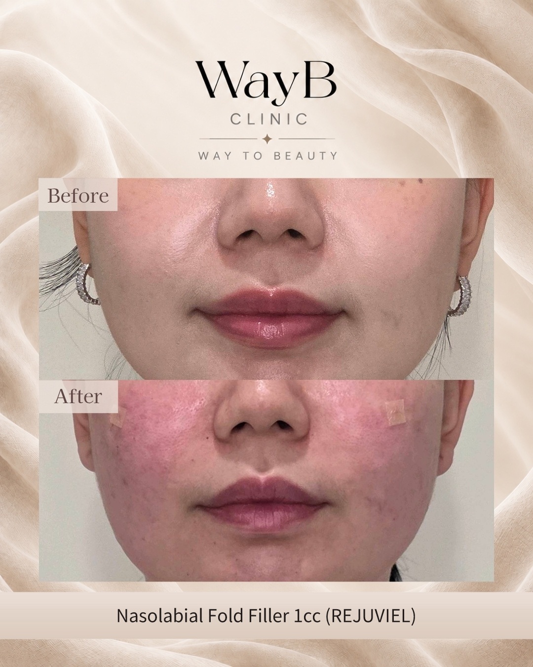 Nasolabial Fold Filler Case 2 Before & After