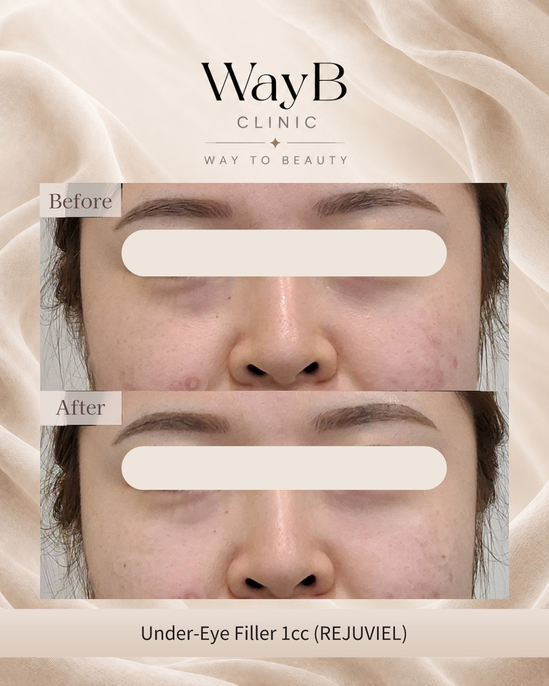 Under-Eye Filler Case 2 Before & After