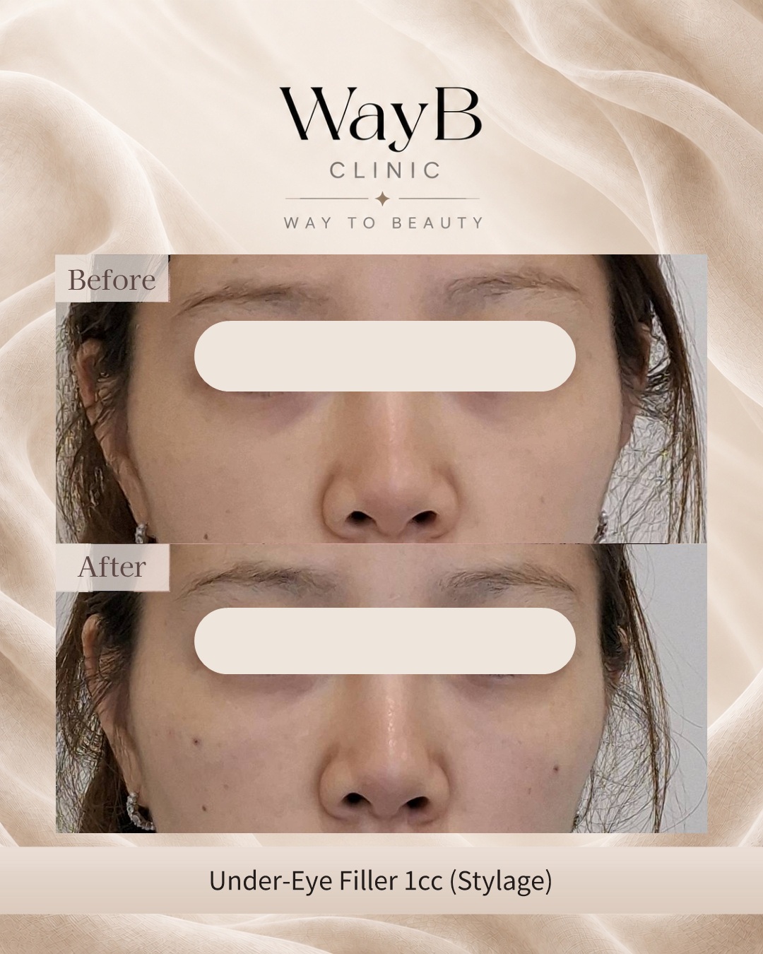 Under-Eye Filler Case 3 Before & After