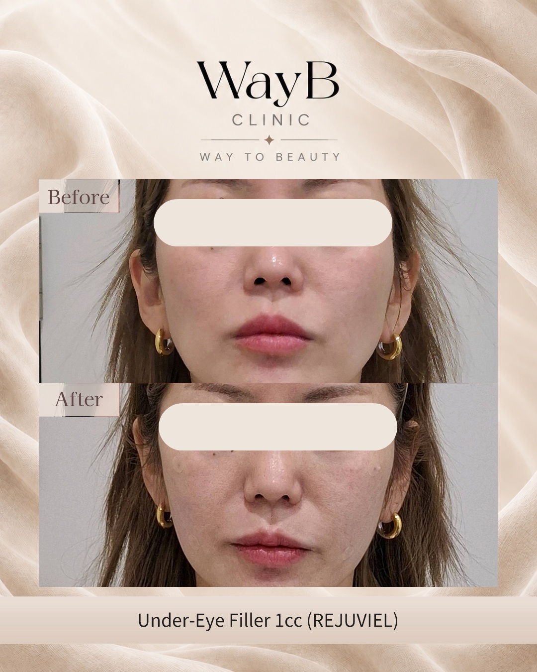 Under-Eye Filler Case 4 Before & After