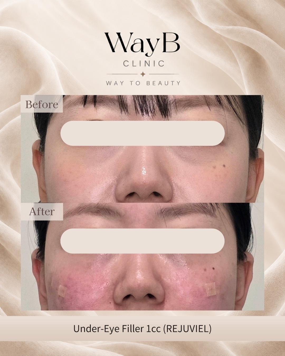 Under-Eye Filler Case 5 Before & After