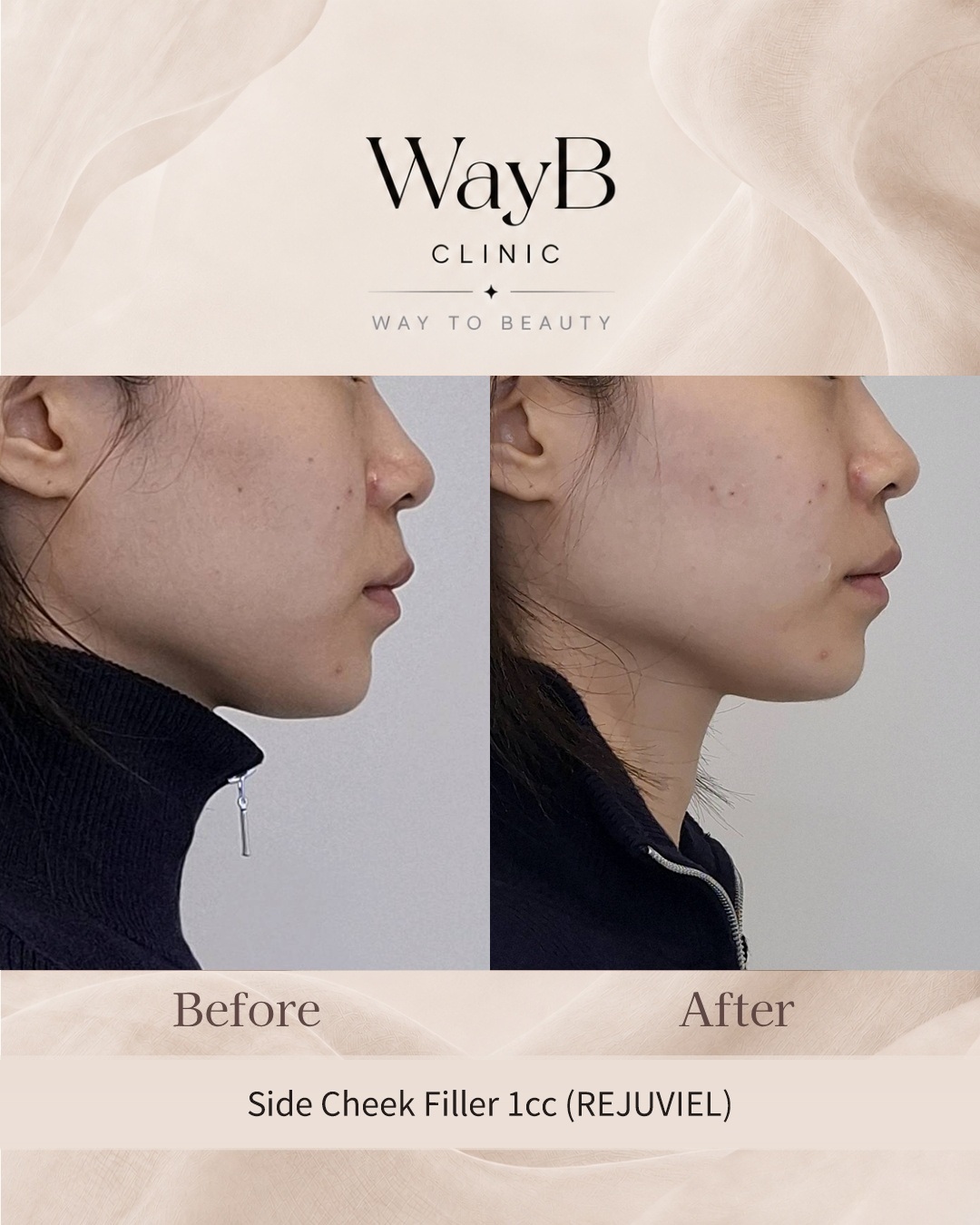 Cheek Filler Case 1 Before & After