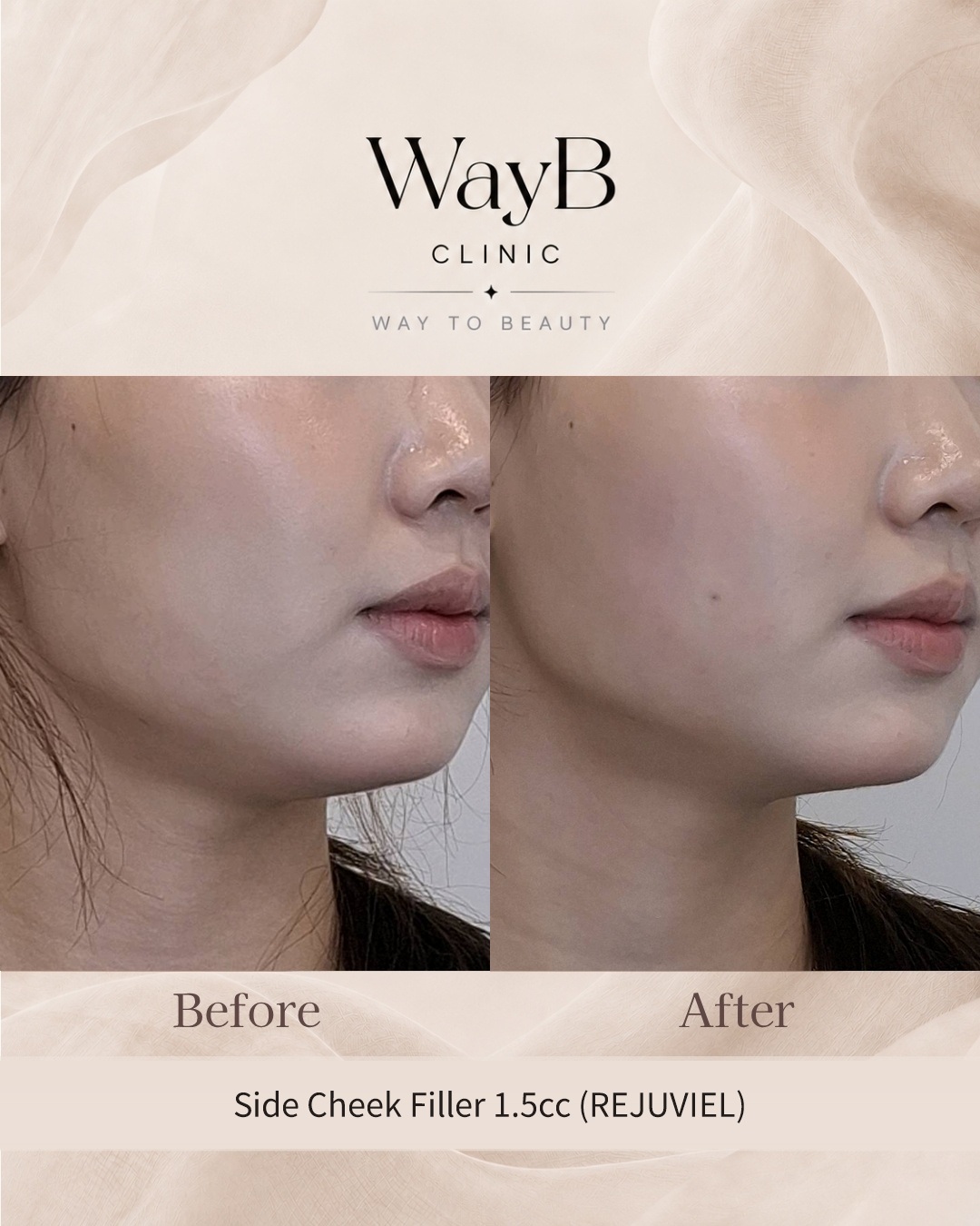 Cheek Filler Case 2 Before & After