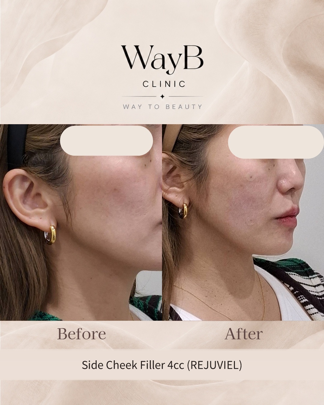 Cheek Filler Case 3 Before & After
