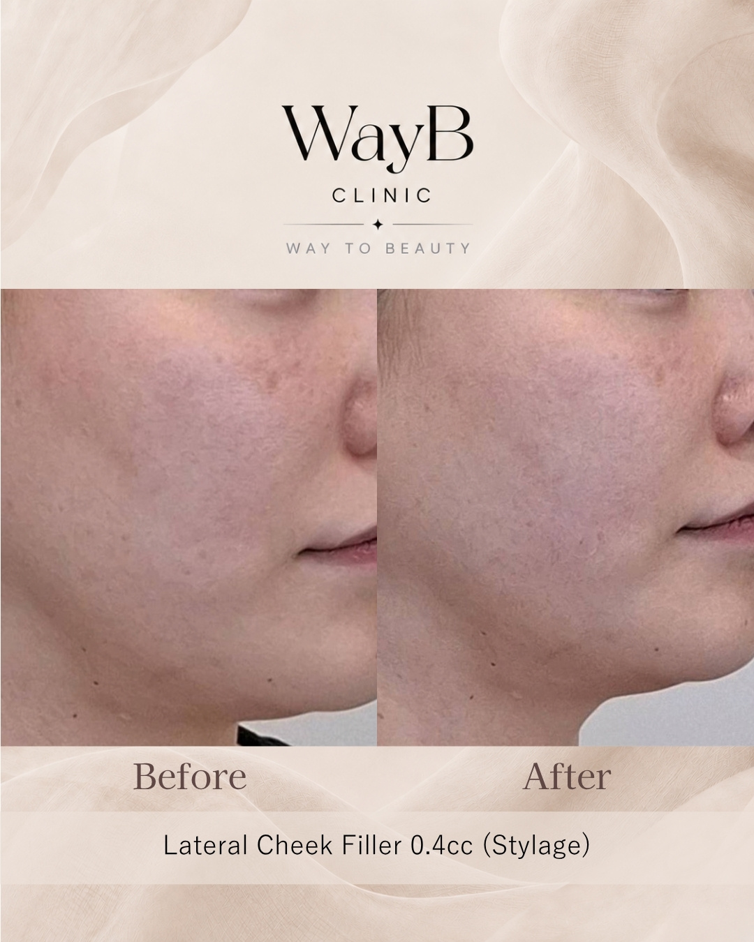 Cheek Filler Case 4 Before & After