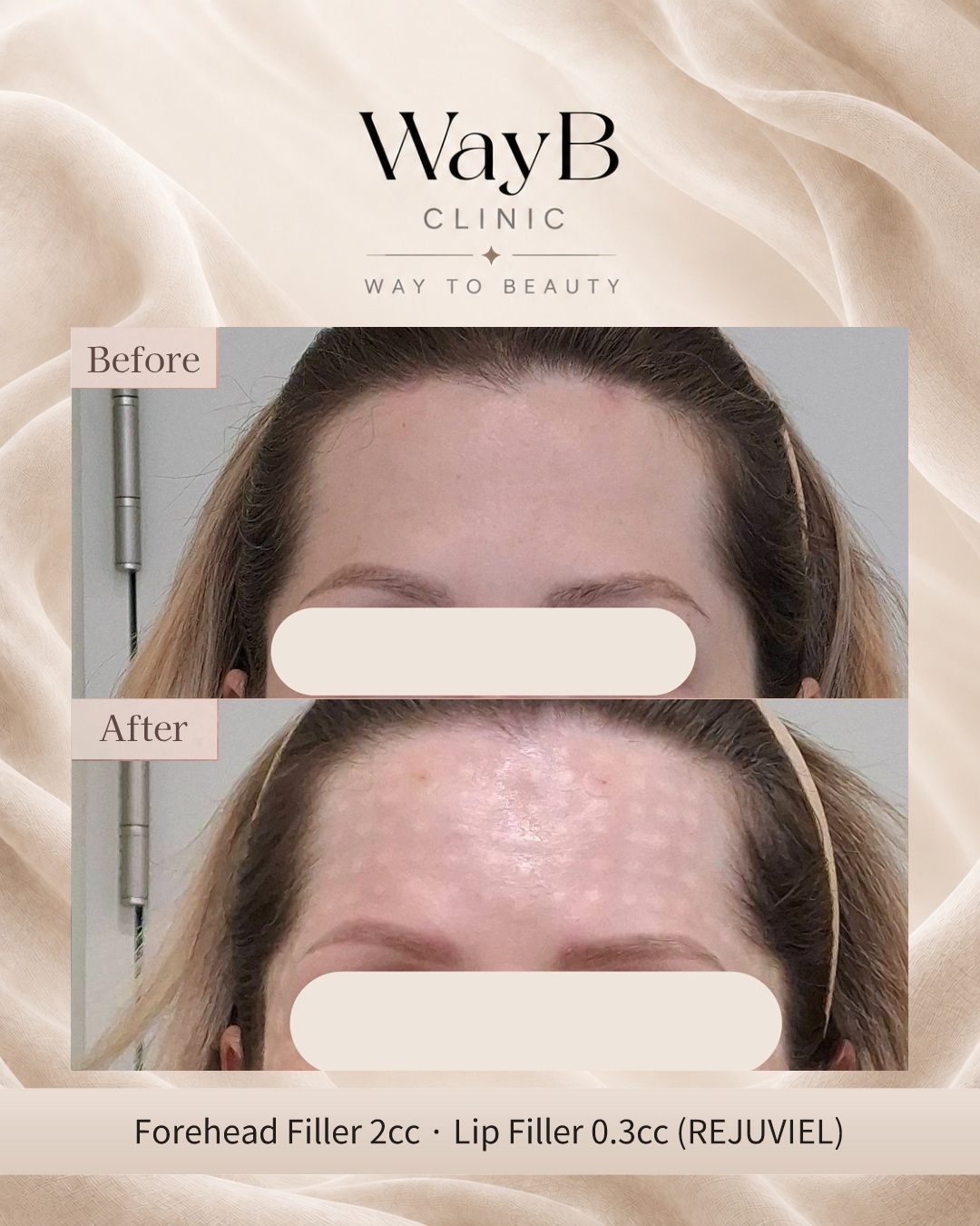 Forehead Filler Case 3 Before & After