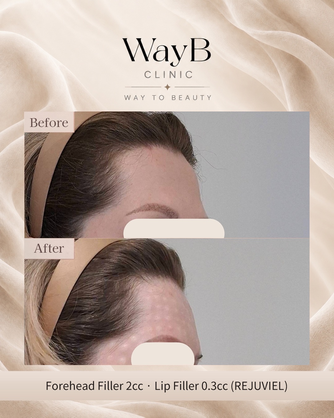 Forehead Filler Case 3 Before & After