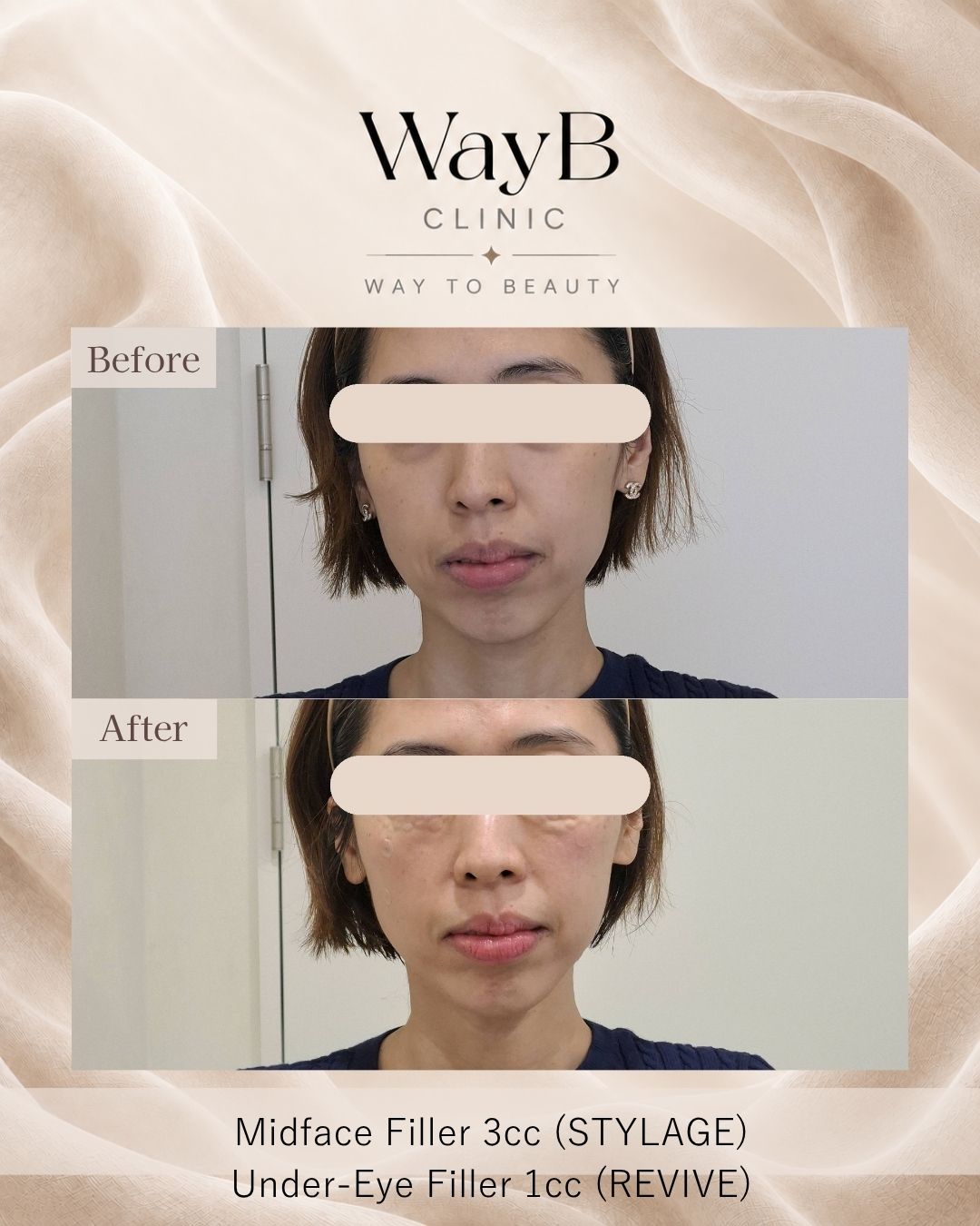 Under-Eye Filler Case 6 Before & After