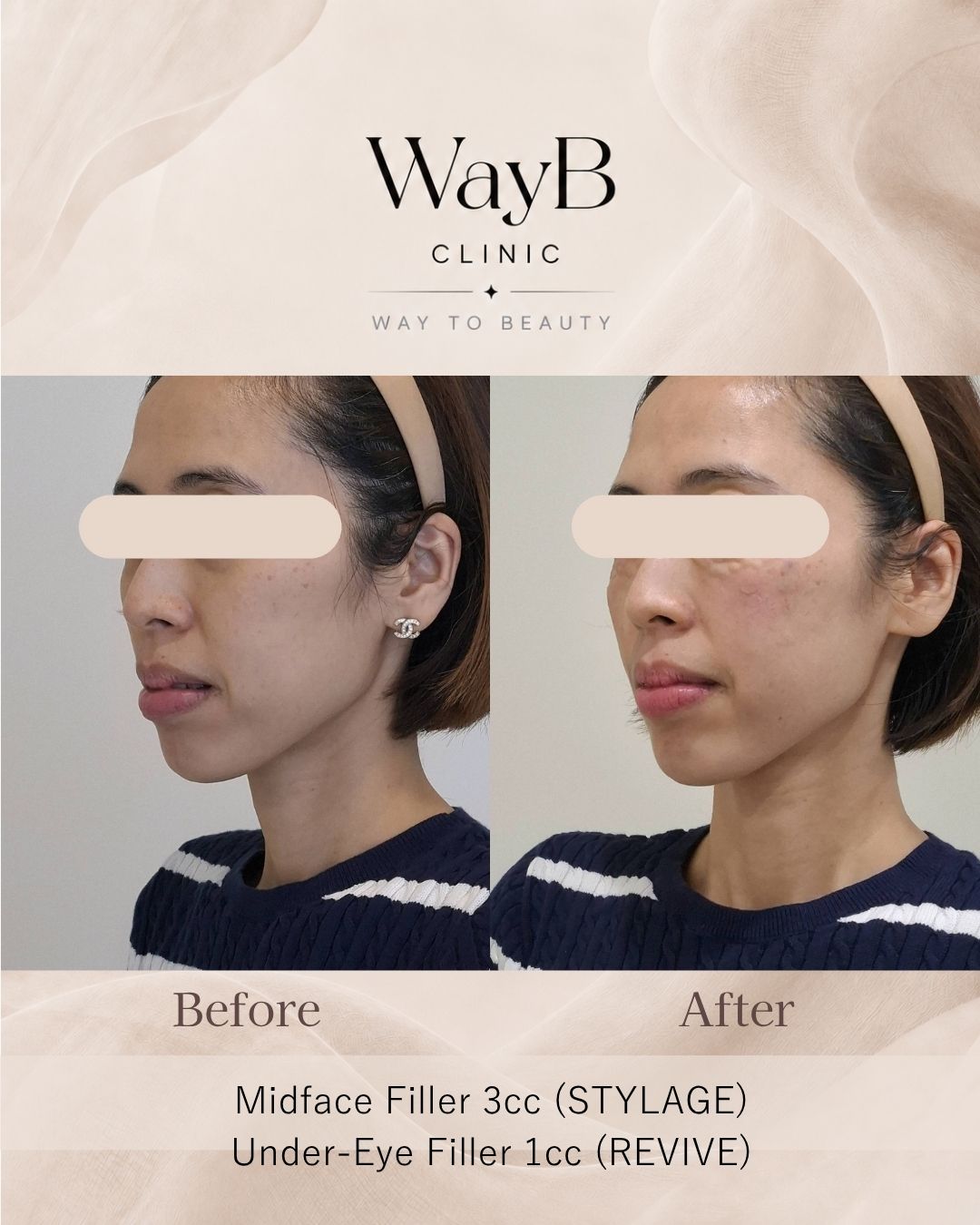Under-Eye Filler Case 6 Before & After