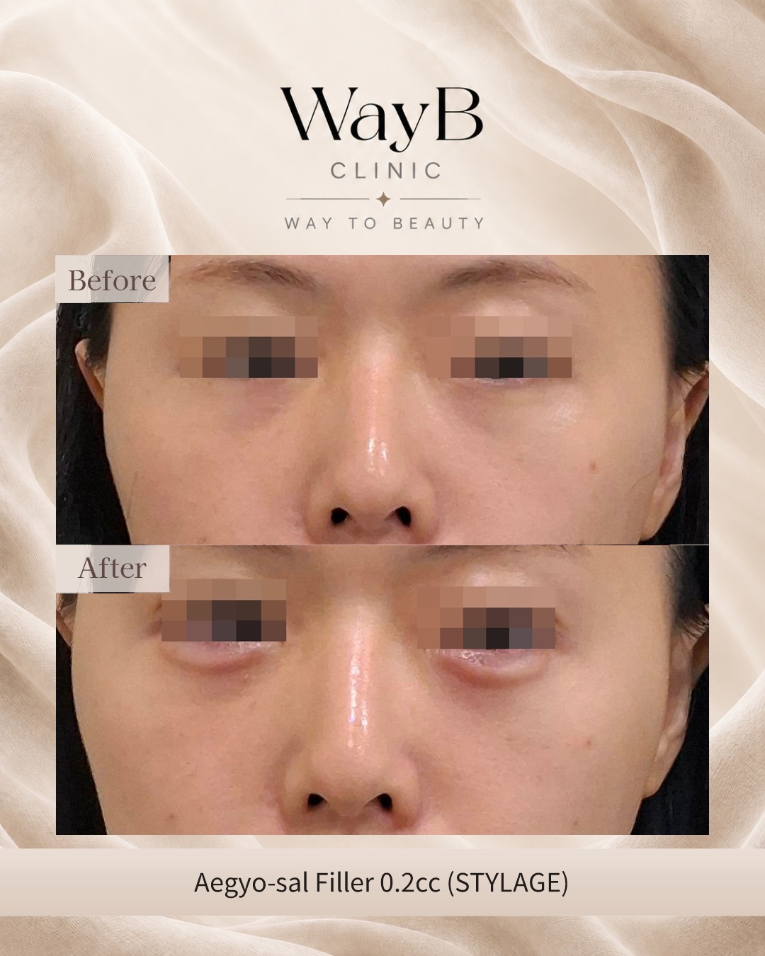Under-Eye Filler Case 7 Before & After