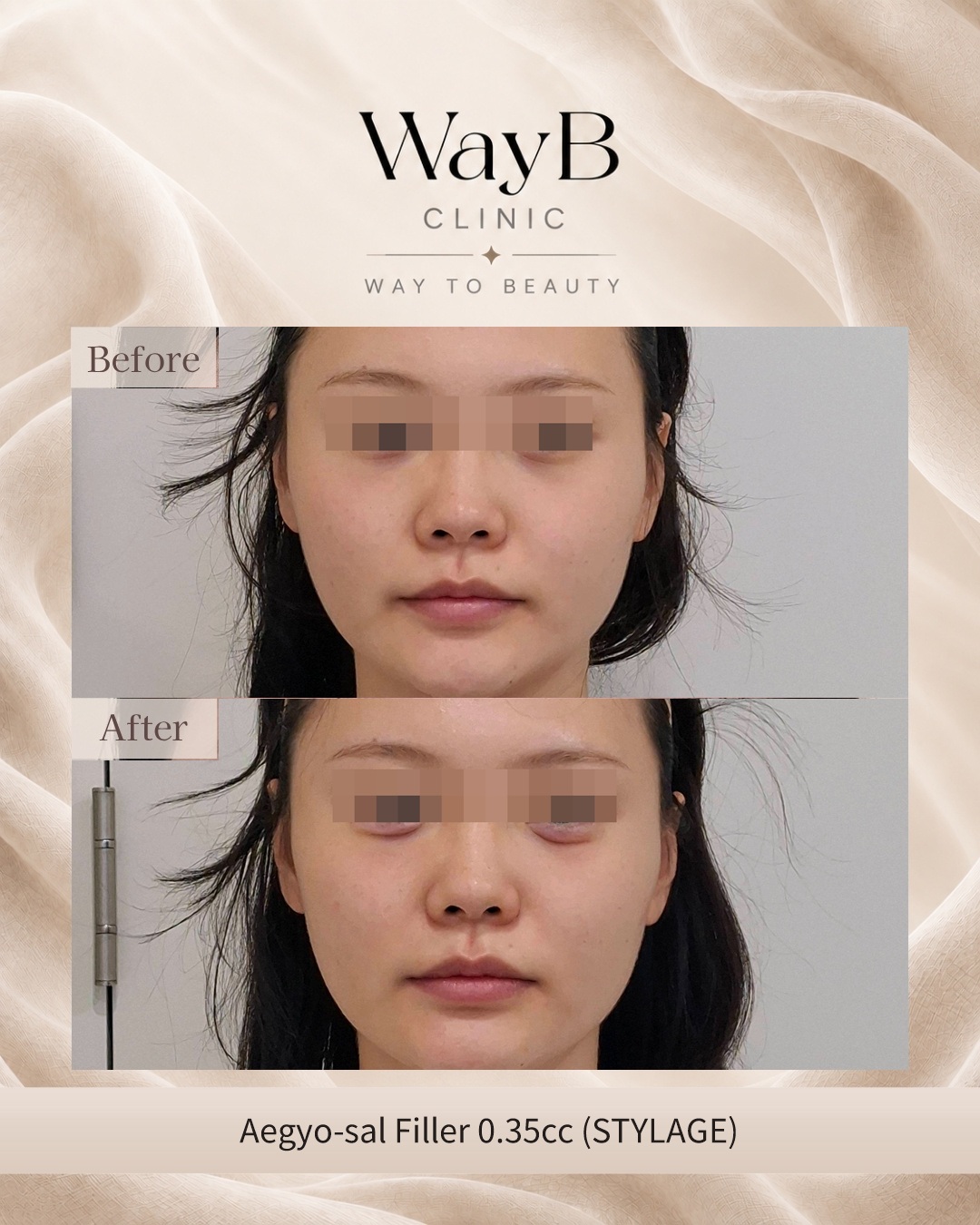 Under-Eye Filler Case 8 Before & After