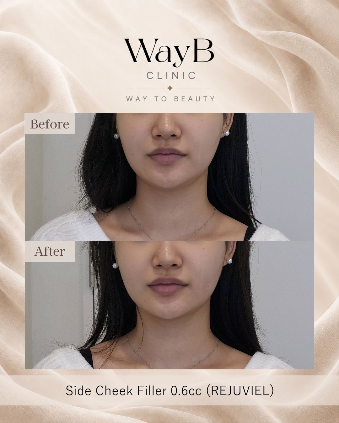 Cheek Filler Case 7 Before & After