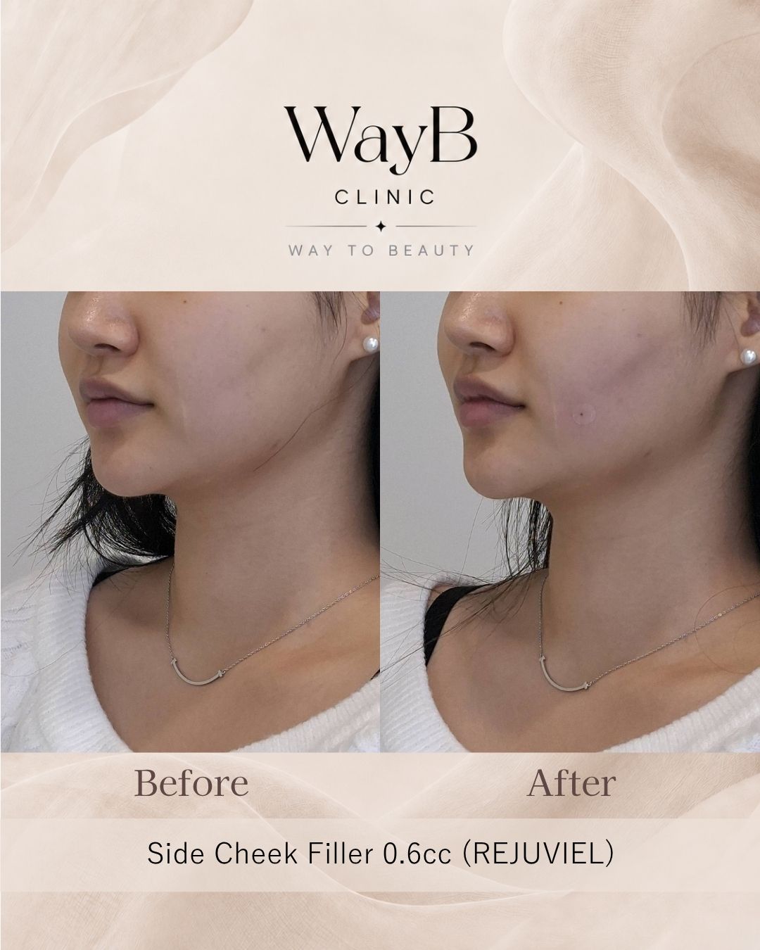 Cheek Filler Case 7 Before & After