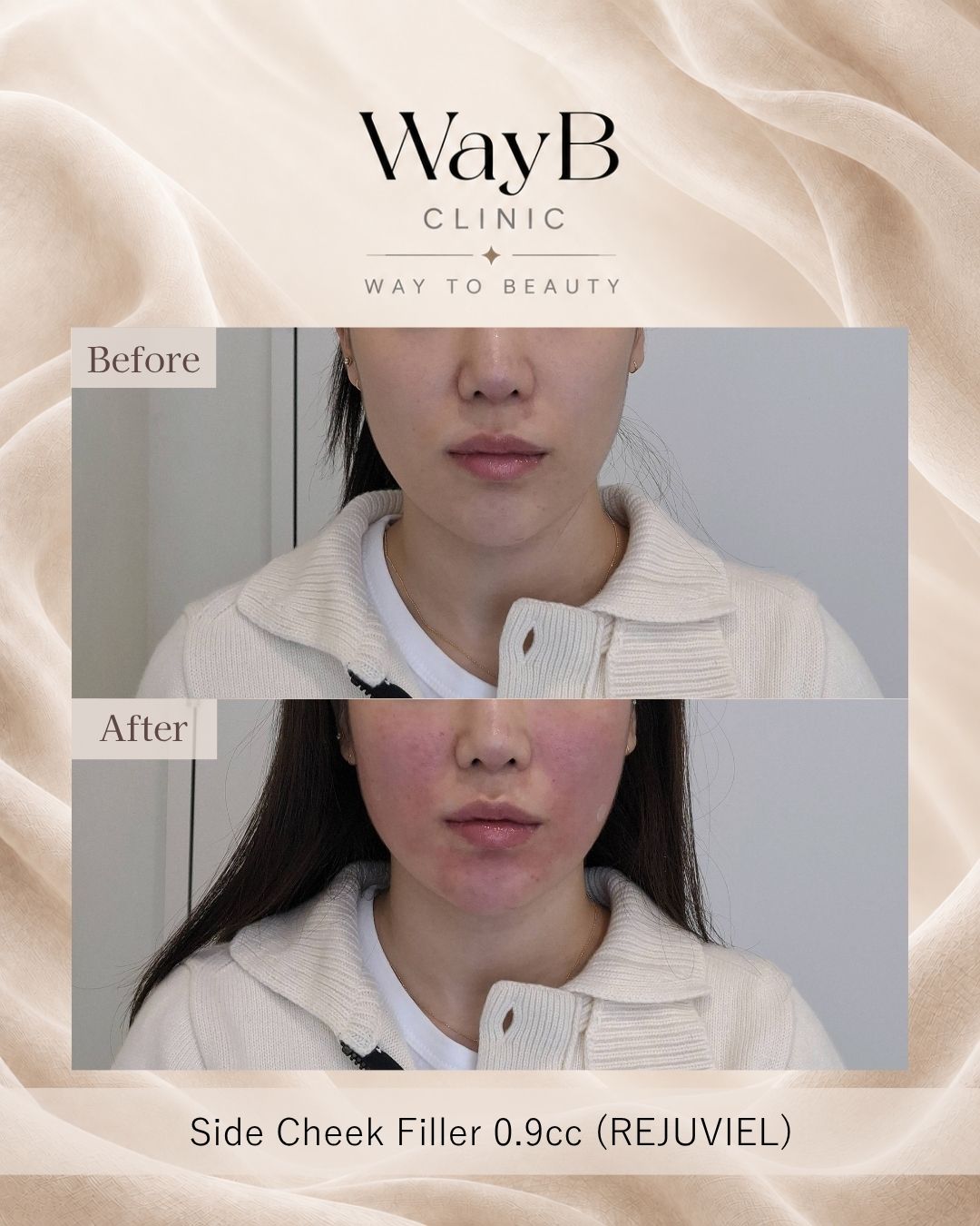 Cheek Filler Case 8 Before & After