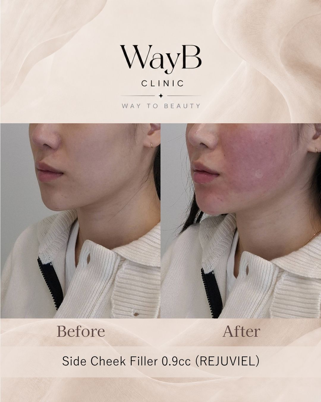 Cheek Filler Case 8 Before & After