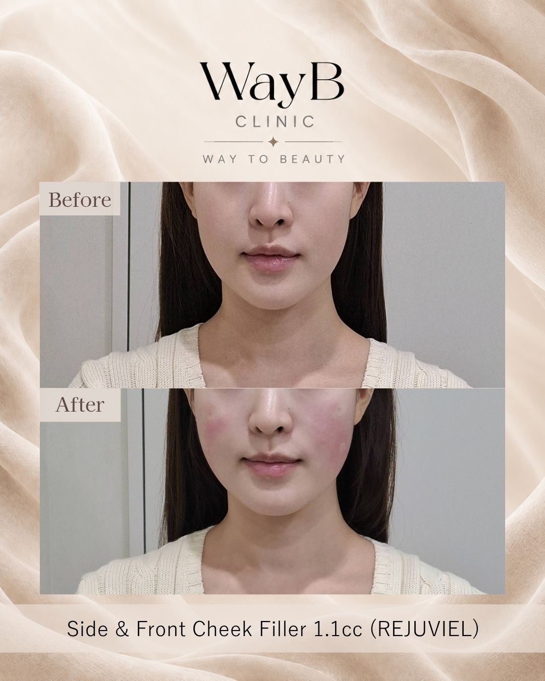 Cheek Filler Case 9 Before & After