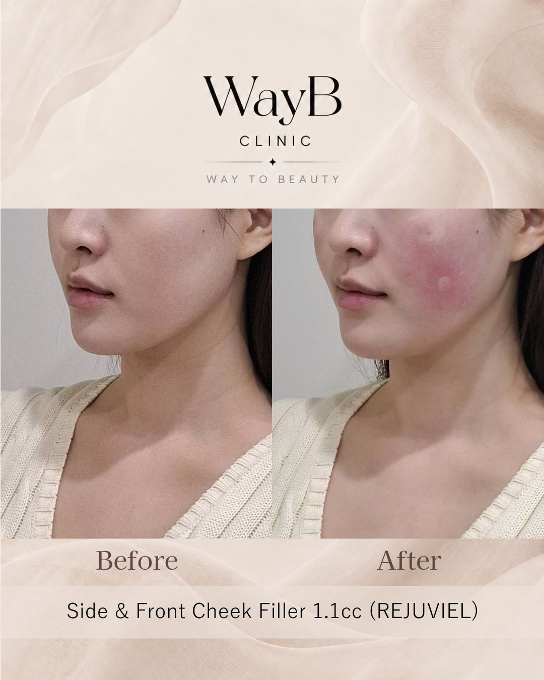 Cheek Filler Case 9 Before & After