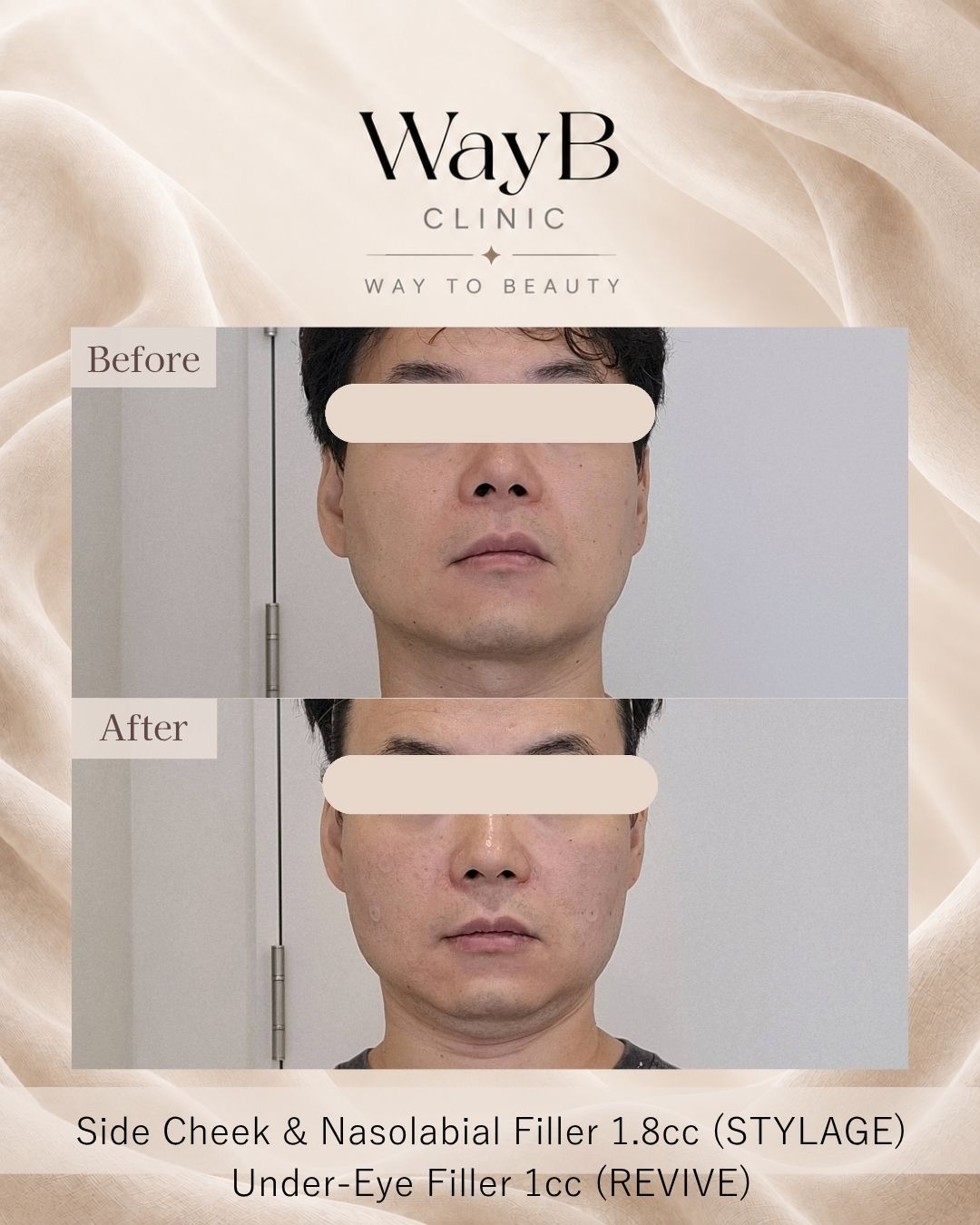 Cheek Filler Case 10 Before & After