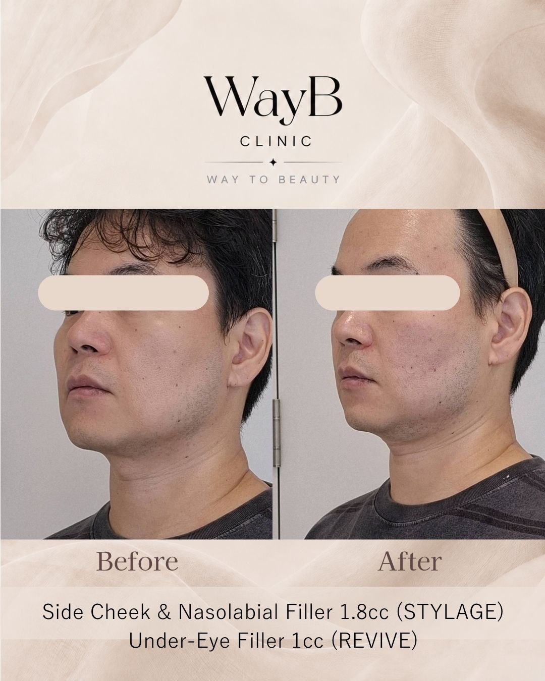 Cheek Filler Case 10 Before & After