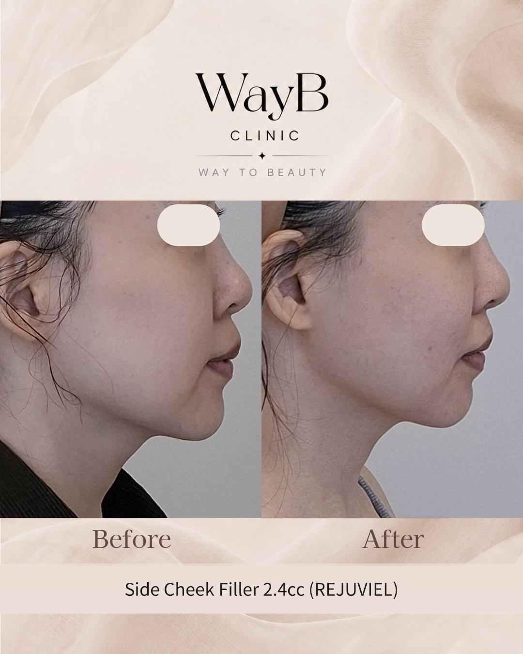 Cheek Filler Case 11 Before & After