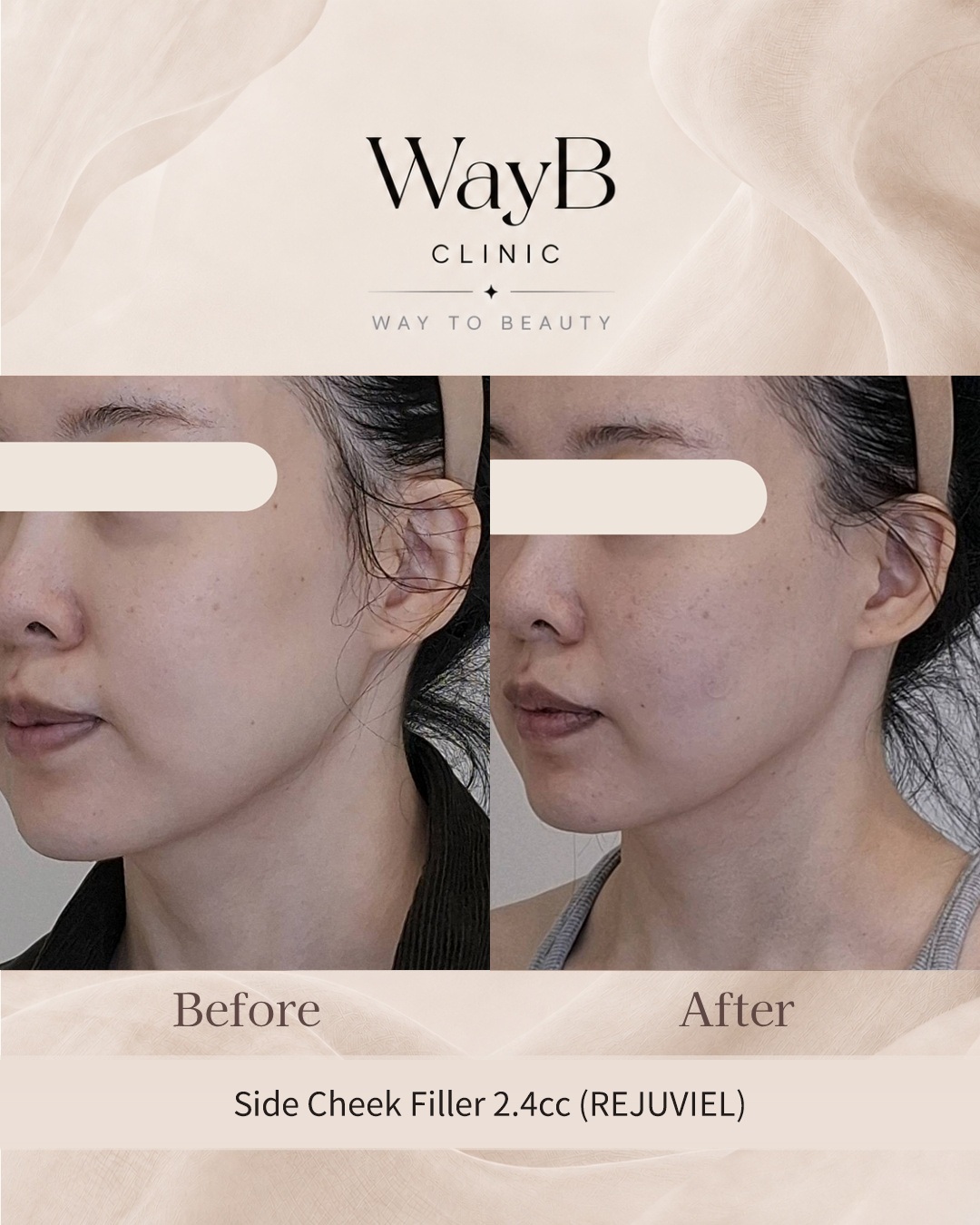 Cheek Filler Case 11 Before & After