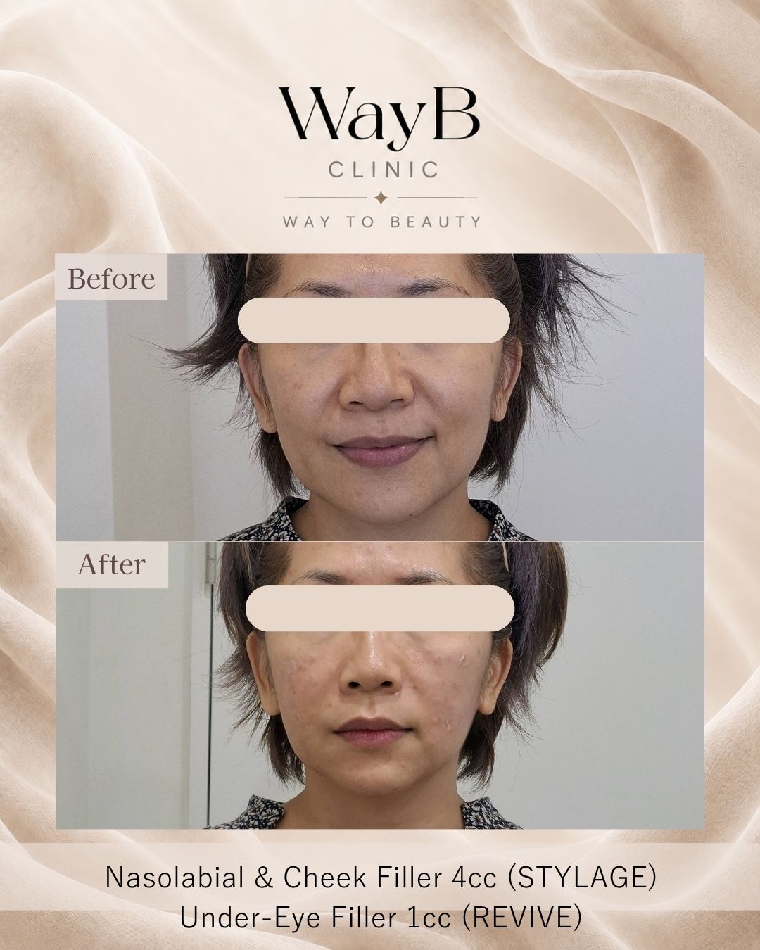 Nasolabial Fold Filler Case 3 Before & After