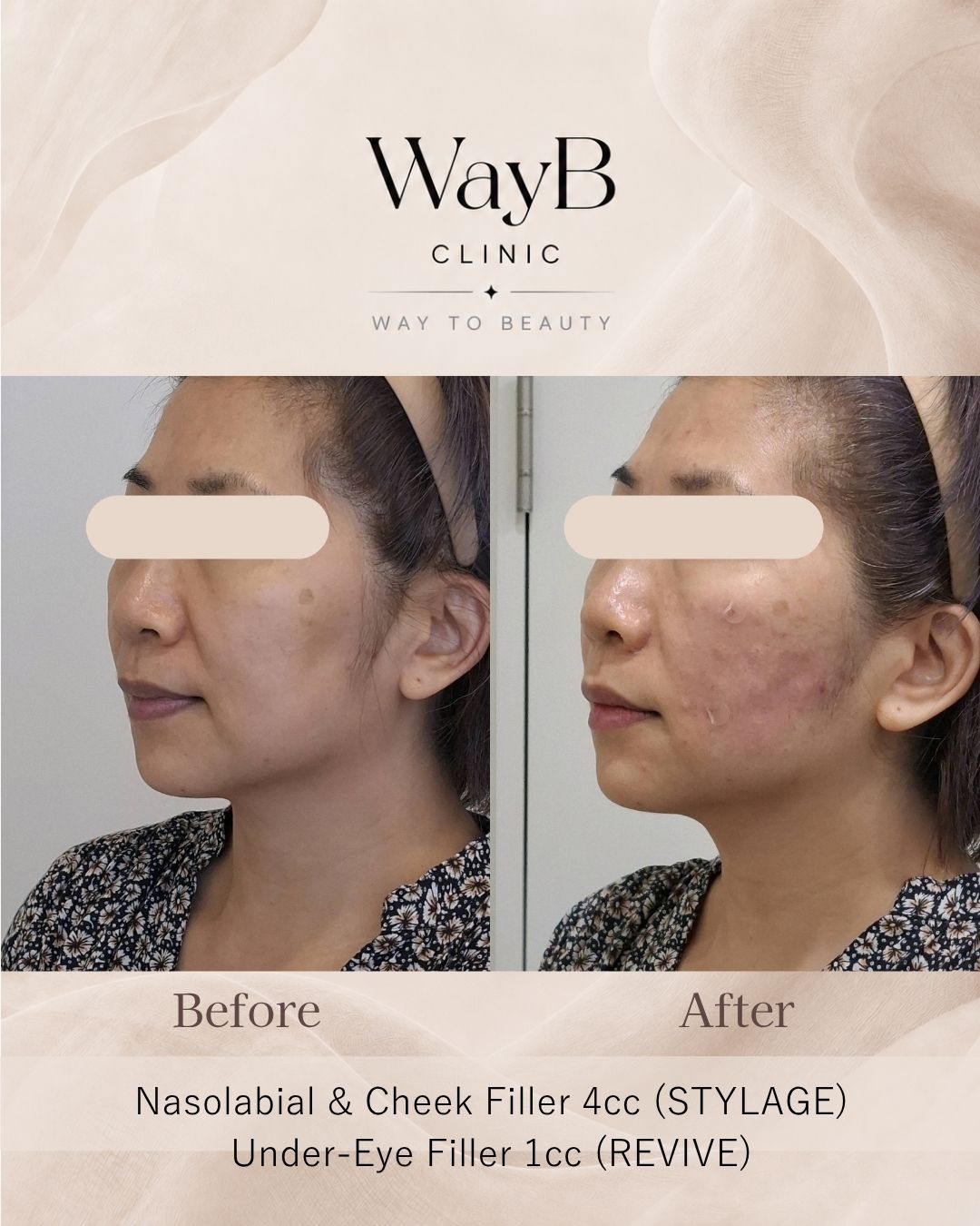 Nasolabial Fold Filler Case 3 Before & After