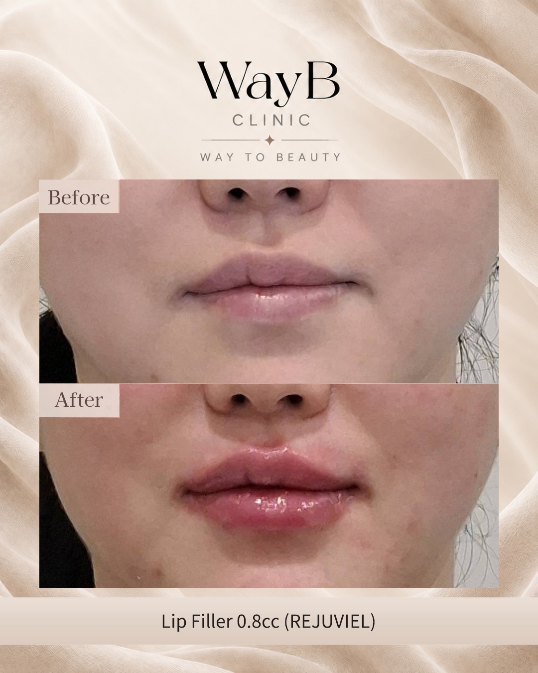 Lip Filler Case 12 Before & After