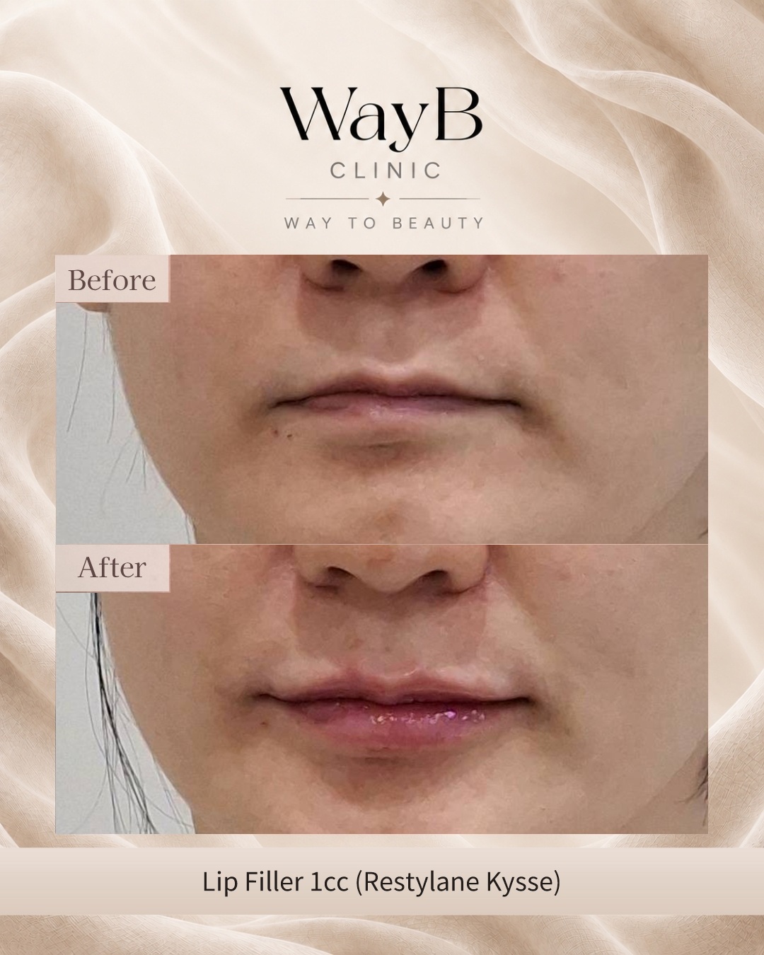 Lip Filler Case 13 Before & After