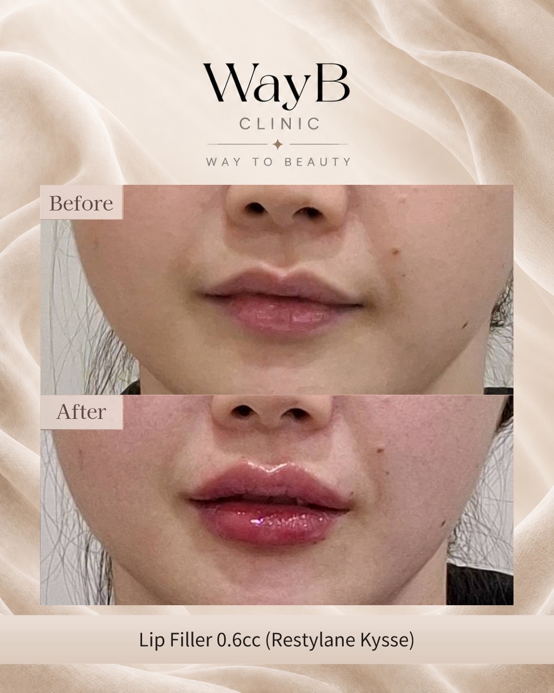 Lip Filler Case 14 Before & After