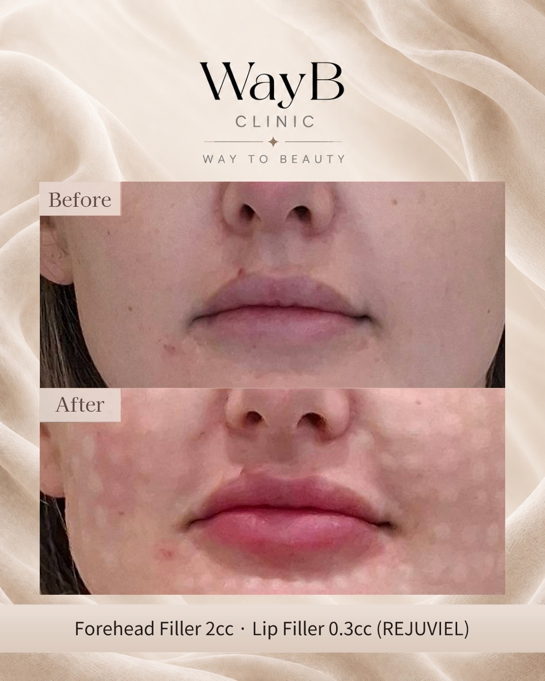 Lip Filler Case 15 Before & After